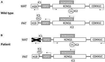 Case Report: A Novel Deletion in the 11p15 Region Causing a Familial Beckwith–Wiedemann Syndrome